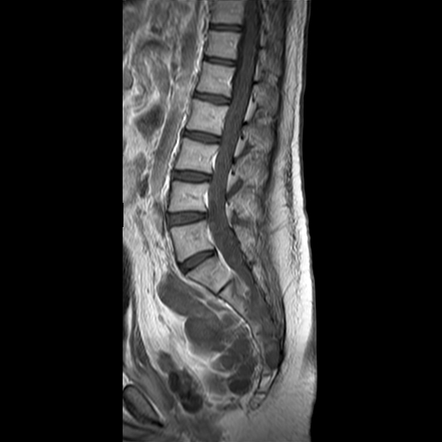 Neurofibromatosis type 1: extensive spinal involvement and Christmas ...