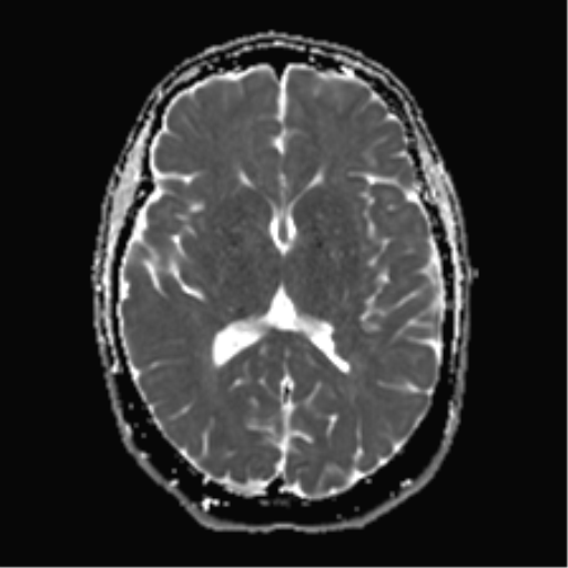 Periventricular heterotopia | Image | Radiopaedia.org