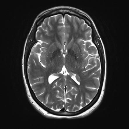 Periventricular heterotopia | Image | Radiopaedia.org