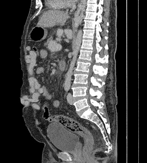 Caput medusae | Image | Radiopaedia.org