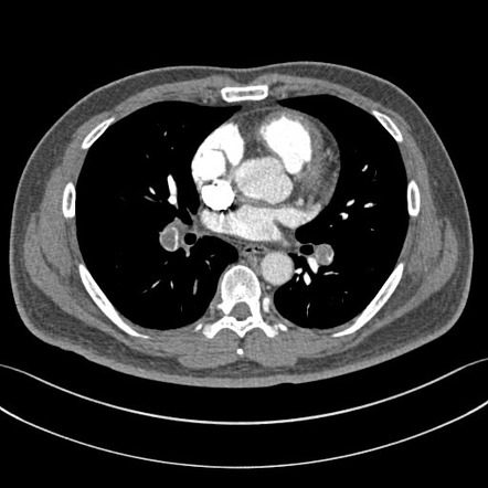 Saddle embolus | Image | Radiopaedia.org