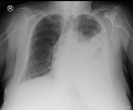 Lung adenocarcinoma - occult in collapsed lung | Radiology Case ...