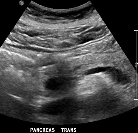 Pancreatic Neuroendocrine Tumor | Image | Radiopaedia.org