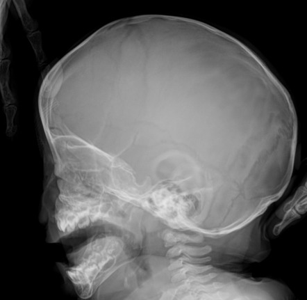 Scaphocephaly | Image | Radiopaedia.org