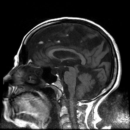 Fatty falx cerebri | Image | Radiopaedia.org