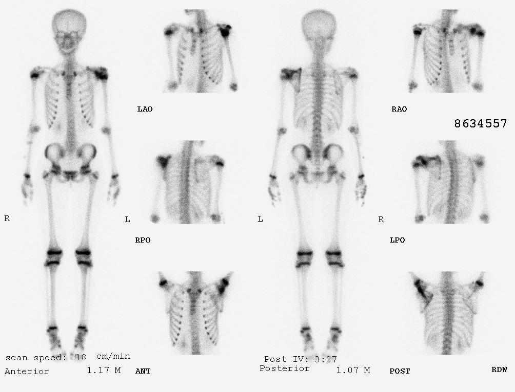 Ewings Sarcoma Of Scapula Image 8756