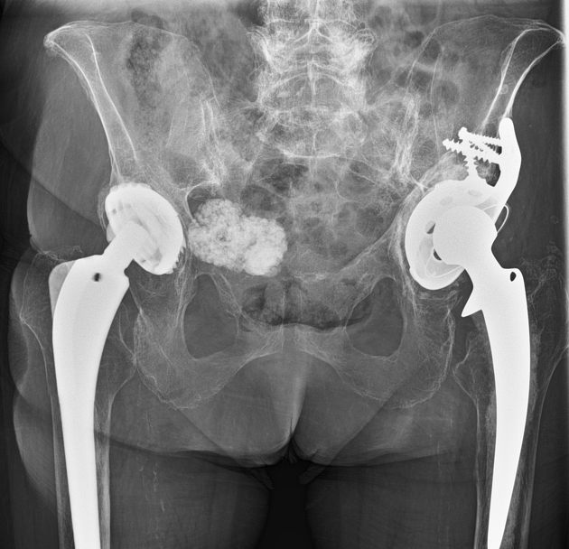 Vancouver B1 periprosthetic hip fracture | Radiology Case 