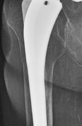 Periprosthetic fracture | Radiology Reference Article | Radiopaedia.org