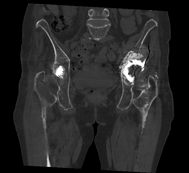 Vancouver B1 periprosthetic hip fracture | Radiology Case 