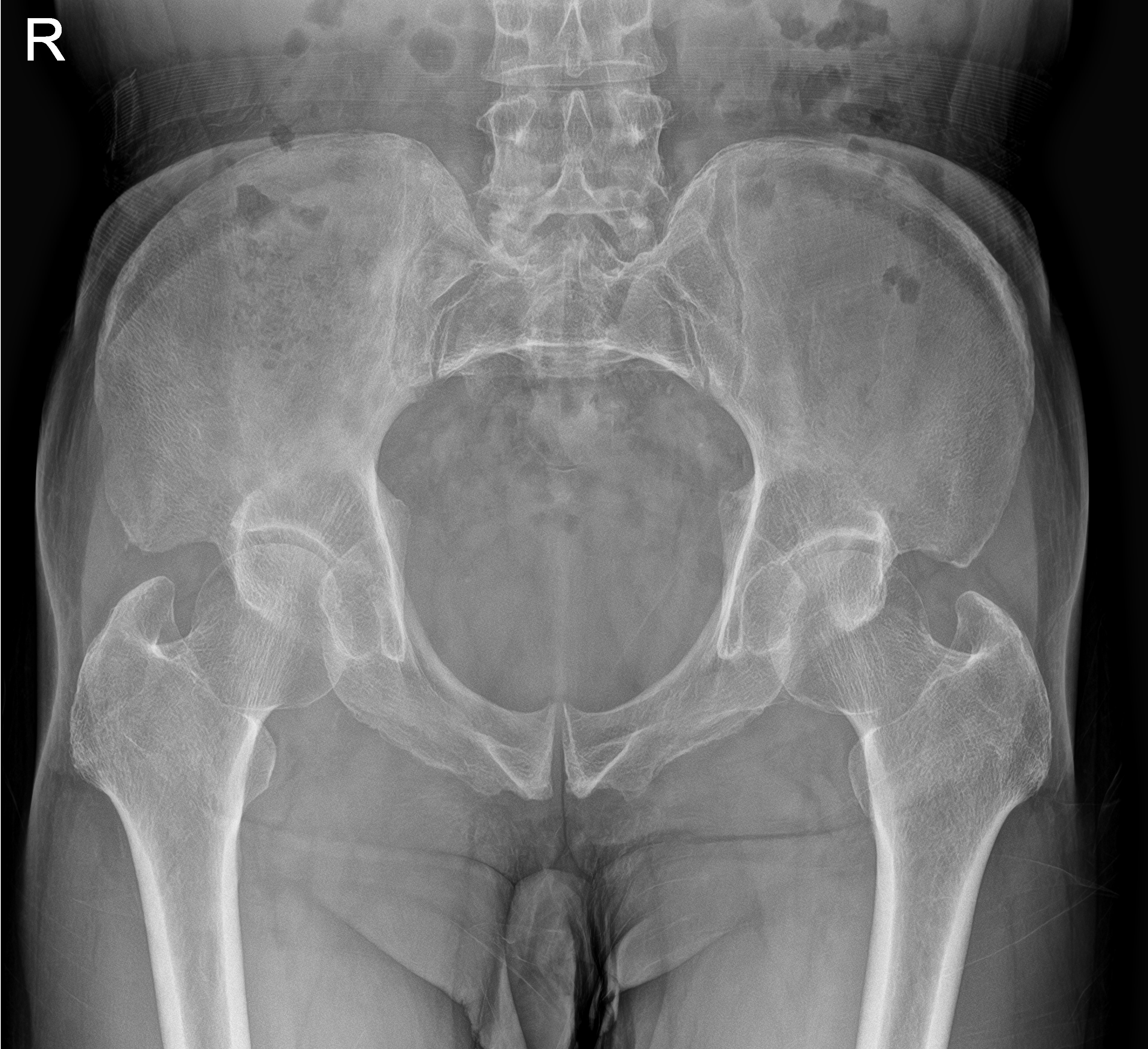 paget-disease-of-the-pelvis-image-radiopaedia