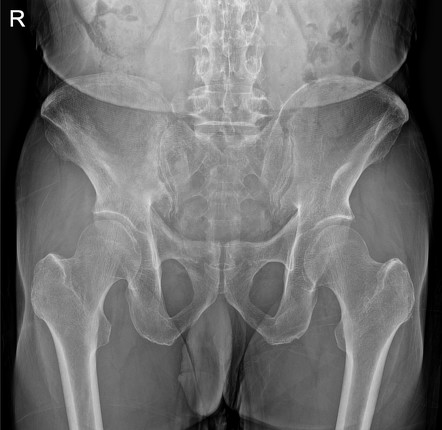 Paget disease of the pelvis | Image | Radiopaedia.org