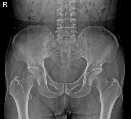 Paget disease of the pelvis | Image | Radiopaedia.org