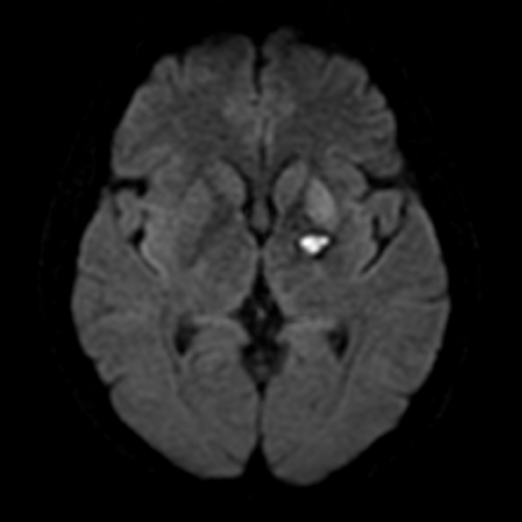 Basal ganglia bleed | Image | Radiopaedia.org