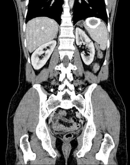 Splenic calcified hydatid cyst | Image | Radiopaedia.org