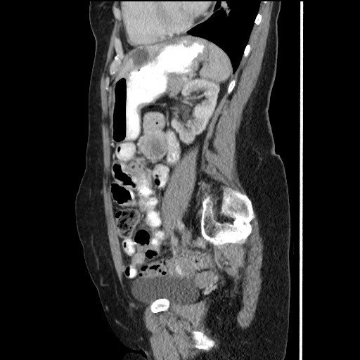 Gastrointestinal stromal tumor (GIST) - duodenojejunal flexure | Image ...