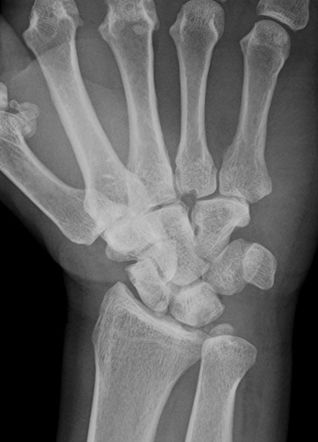 Accessory ossicle of wrist (paranavicular) | Image | Radiopaedia.org