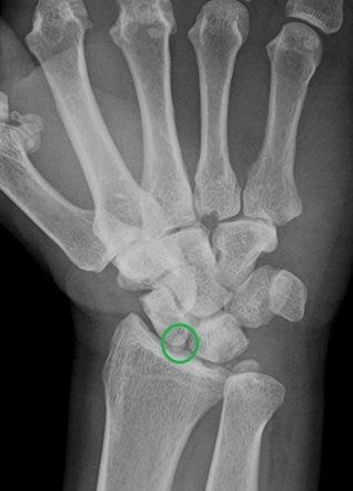 Accessory ossicles of the wrist | Radiology Reference Article ...