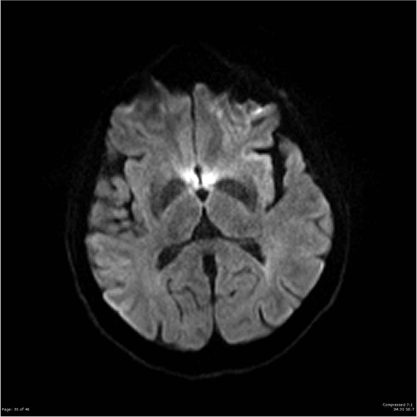 Colloid cyst | Image | Radiopaedia.org