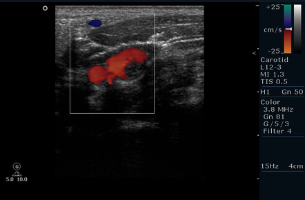 Carotid free-floating thrombus | Radiology Case | Radiopaedia.org