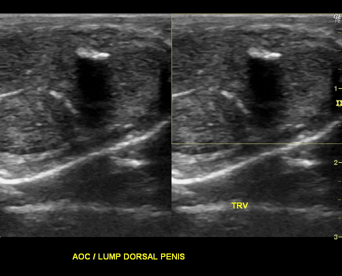 Peyronie Disease Image