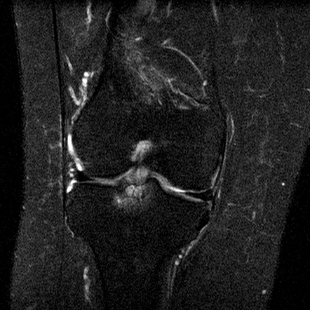 Anterior cruciate ligament mucoid degeneration | Image | Radiopaedia.org