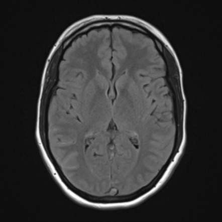 Dural venous sinus thrombosis | Image | Radiopaedia.org