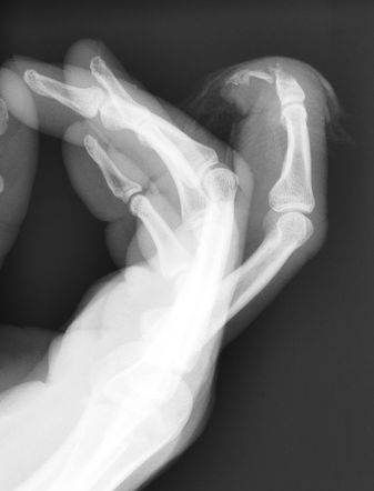 Amputated finger | Radiology Case | Radiopaedia.org