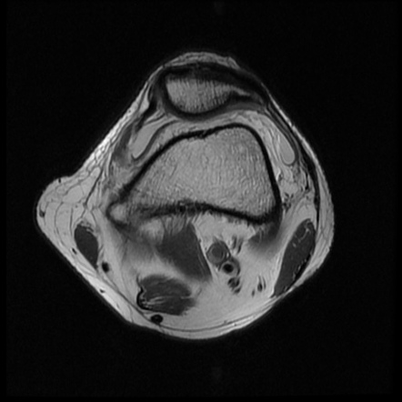 Bucket-handle Meniscal Tear | Image | Radiopaedia.org