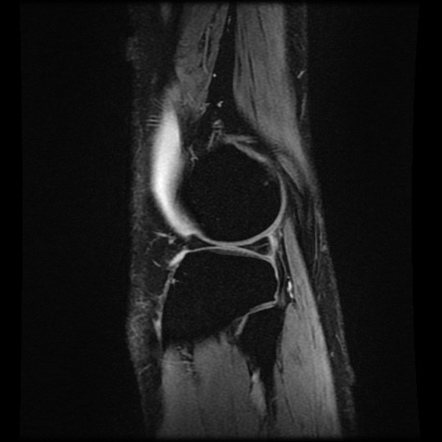 Bucket-handle meniscal tear | Image | Radiopaedia.org