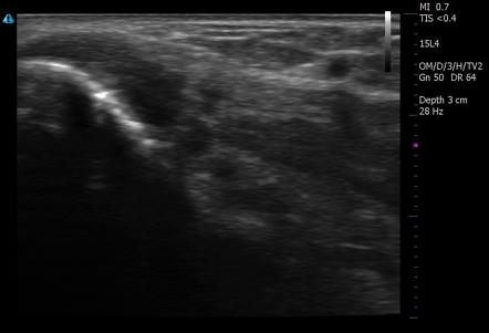 Lateral epicondylitis | Radiology Reference Article | Radiopaedia.org