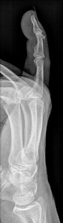 Mallet finger | Radiology Case | Radiopaedia.org