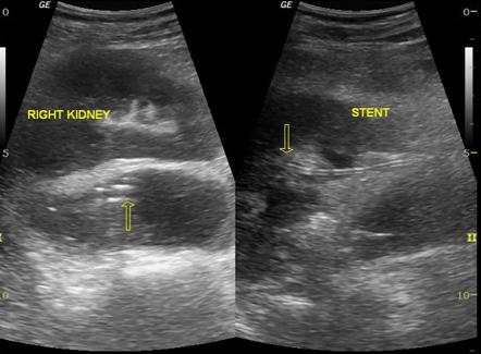 Perinephric Abscess Ultrasound