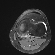 Posteromedial corner injury of the knee | Radiology Reference Article ...