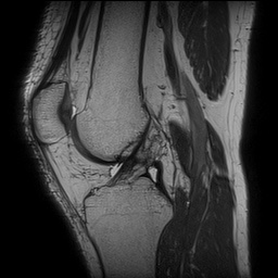 Posteromedial corner injury of the knee | Image | Radiopaedia.org