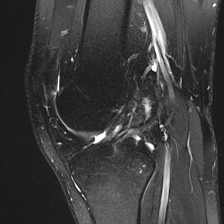 Posteromedial corner injury of the knee | Image | Radiopaedia.org