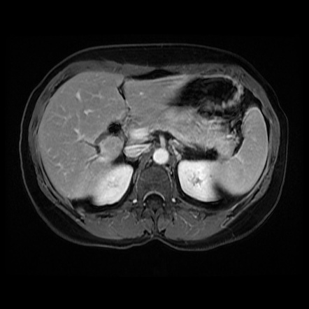 Hepatic pseudolesion due to unrecognized obstruction of right posterior ...