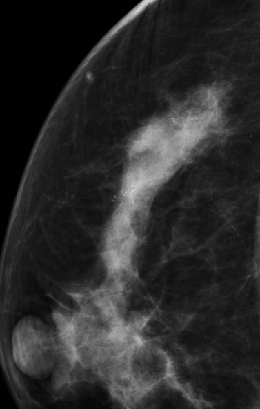 Ductal Carcinoma In Situ (DCIS) | Image | Radiopaedia.org