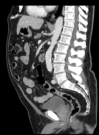 Ileocecal intussusception due to large ileal lipoma | Image ...