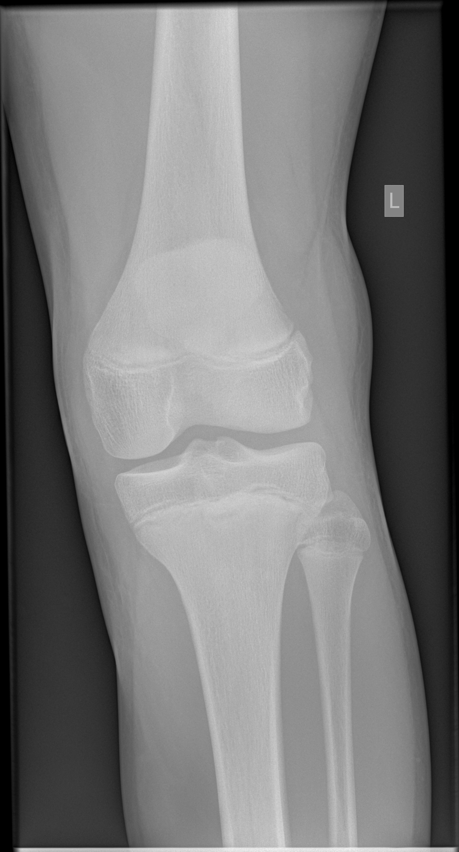 Tibial Tuberosity Avulsion Fracture Image Radiopaedia Org