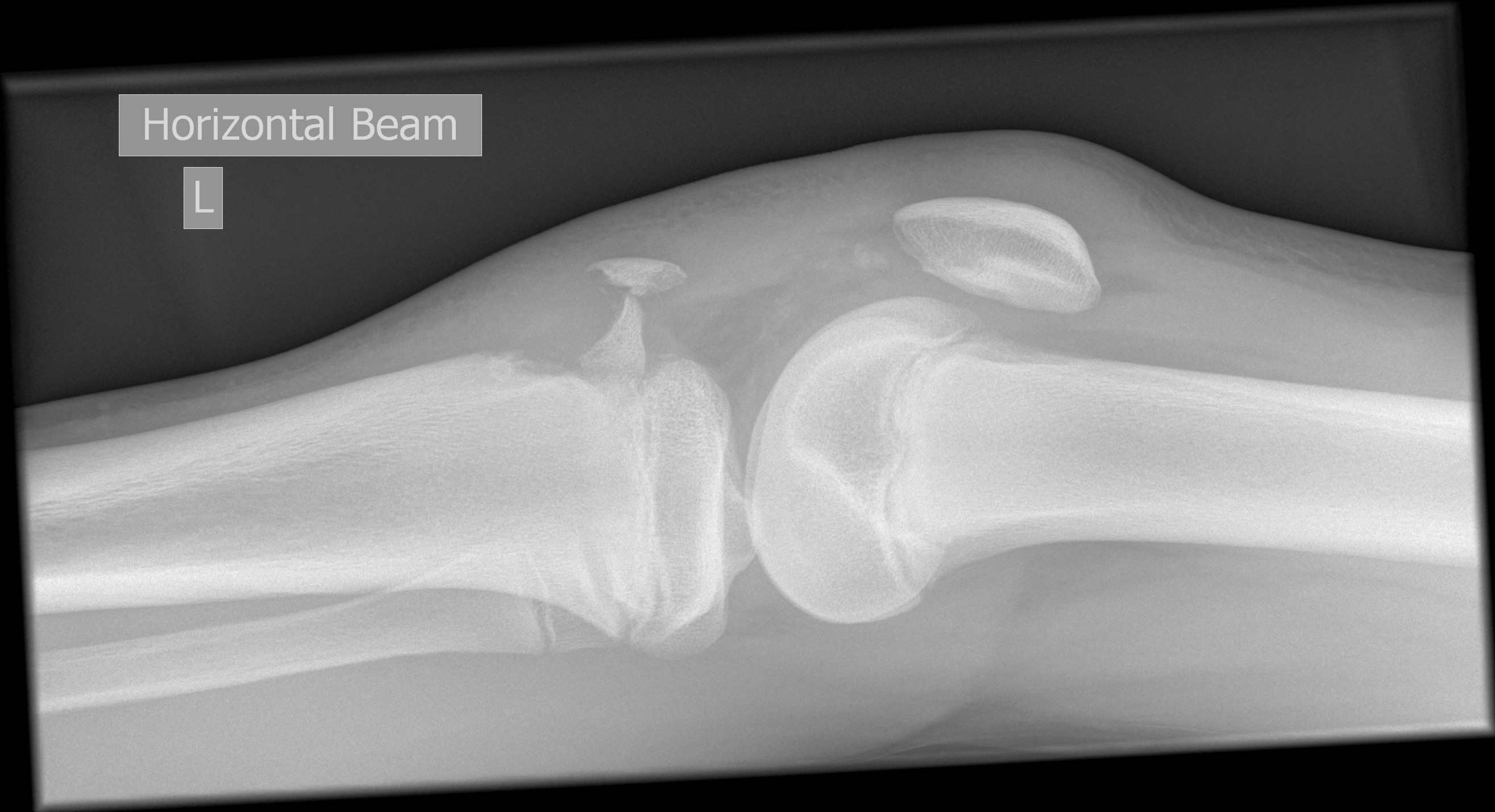 Tibial tuberosity avulsion fracture | Image | Radiopaedia.org