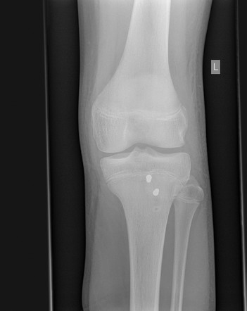 Tibial tuberosity avulsion fracture | Image | Radiopaedia.org