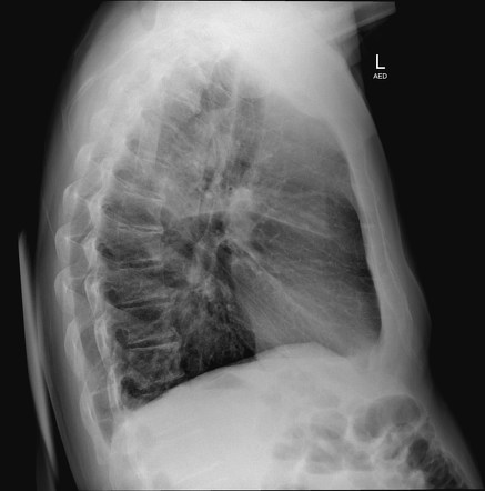 Right upper lobe pneumonia | Image | Radiopaedia.org