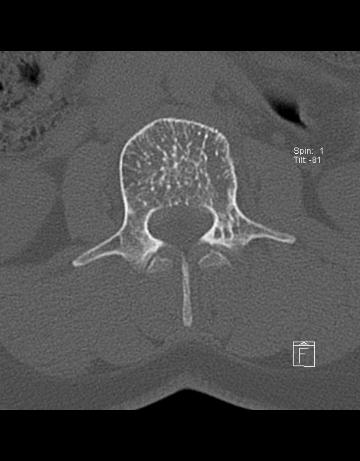 Vertebral Hemangioma With Curtain Sign Image