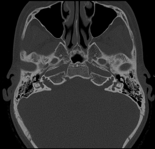 X-Linked Stapes Gusher: CT Findings in One Patient