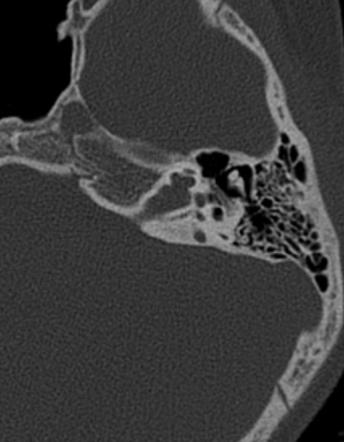 X-linked deafness | Radiology Case | Radiopaedia.org