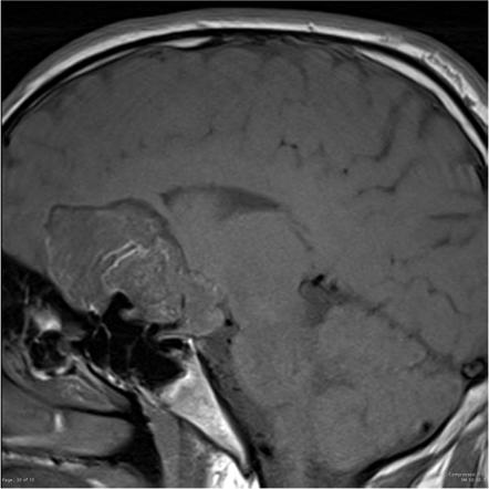 Intracranial Epidermoid Cyst Image Radiopaedia Org