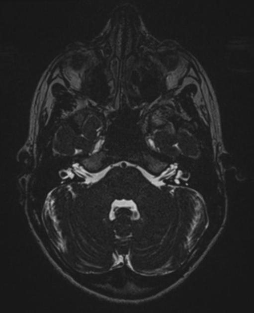 X-Linked Stapes Gusher: CT Findings in One Patient