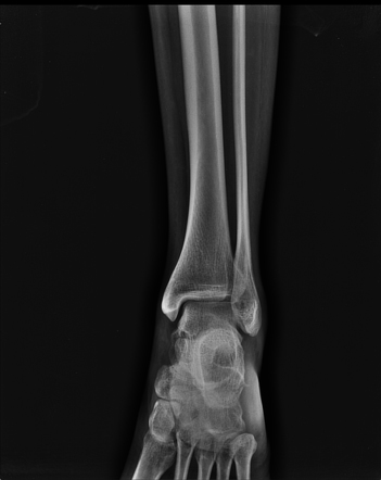 Extensor digitorum brevis avulsion | Image | Radiopaedia.org