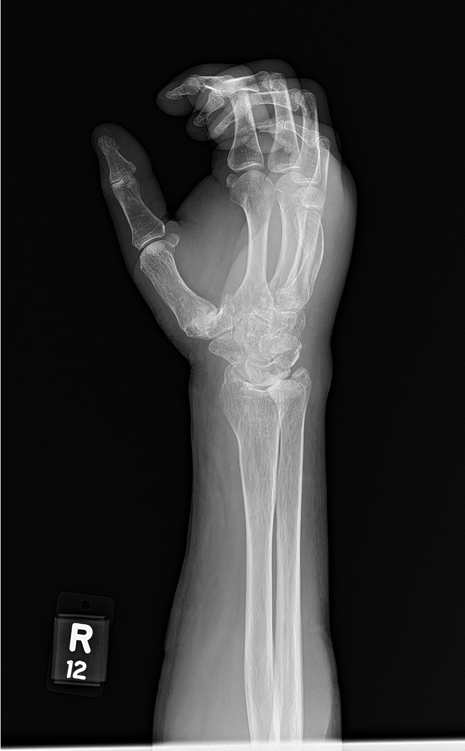 Ulnar impaction syndrome | Image | Radiopaedia.org