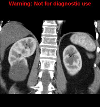 Bosniak Classification System Of Renal Cystic Masses Radiology Reference Article Radiopaedia Org